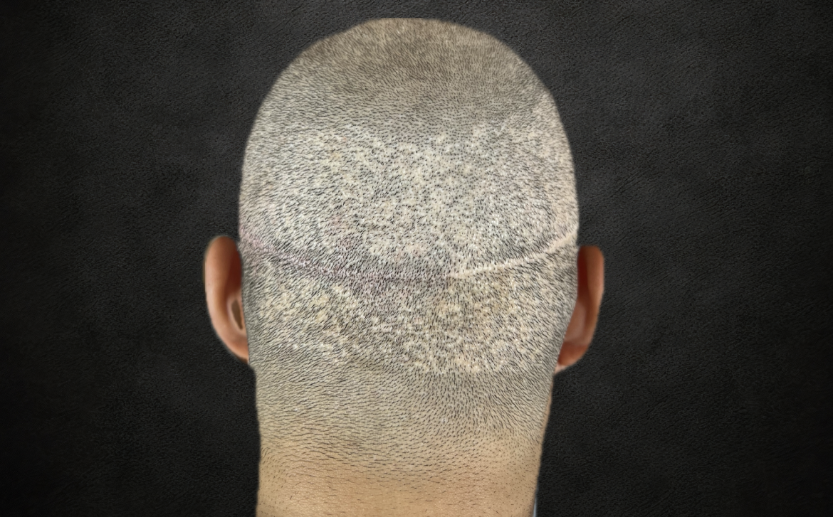 Before-ندبات الزراعة