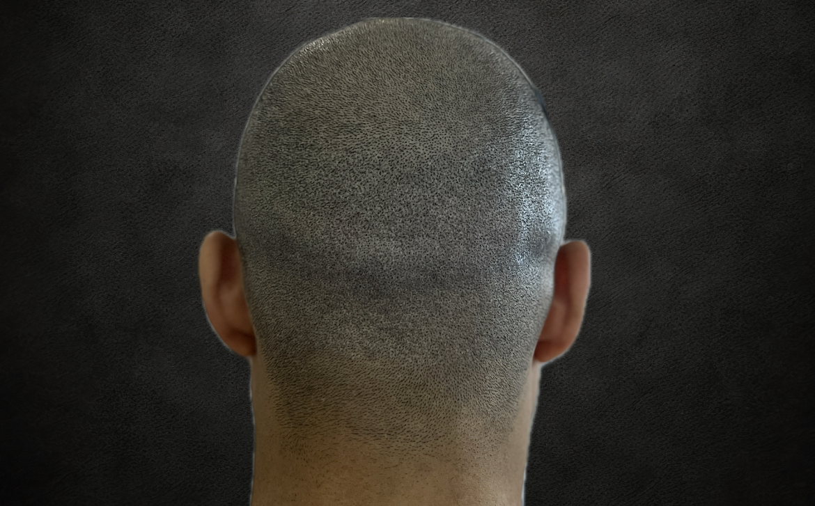 After-ندبات الزراعة