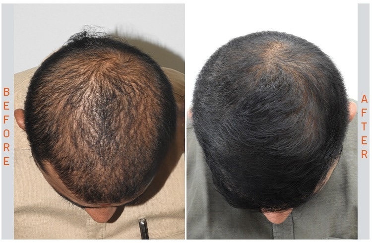 exosomes-hair-treatment 1